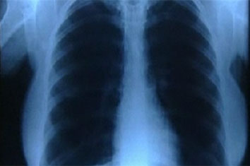 X Ray Radiation >> Dangers Of Ct Scans And X Rays Consumer Reports X Ray Radiation >> Dangers Of Ct Scans And X Rays Consumer Reports