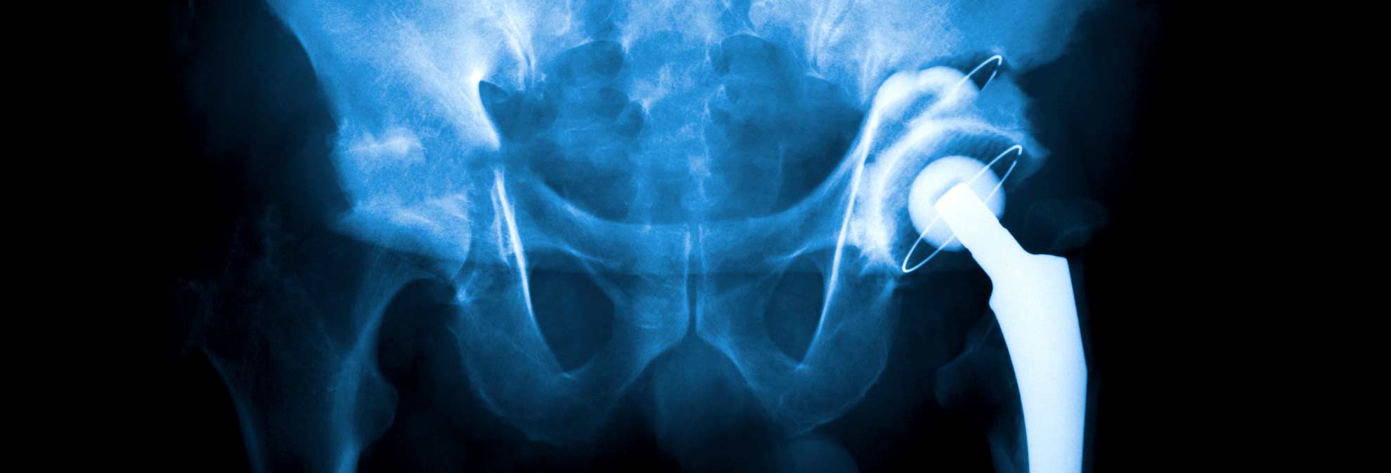 Bike Washing Machine >> What to Do When Getting a Knee or Hip Replaced - Consumer ... Bike Washing Machine >> What to Do When Getting a Knee or Hip Replaced - Consumer ...