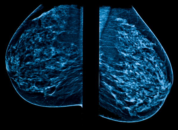 can-radiation-from-mammograms-cause-breast-cancer-consumer-reports