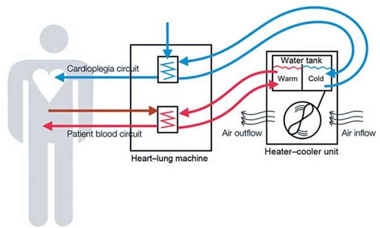 Diagram showing how heater-cooler devices used during lung and heart surgery work. 
