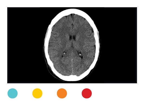 Dangers Of Ct Scans And X Rays Consumer Reports