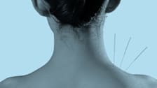detail of back of person's head and neck with 3 acupuncture needles in their neck
