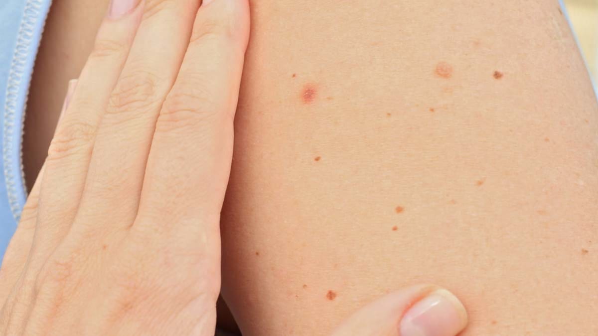 detail of hand checking mole on skin