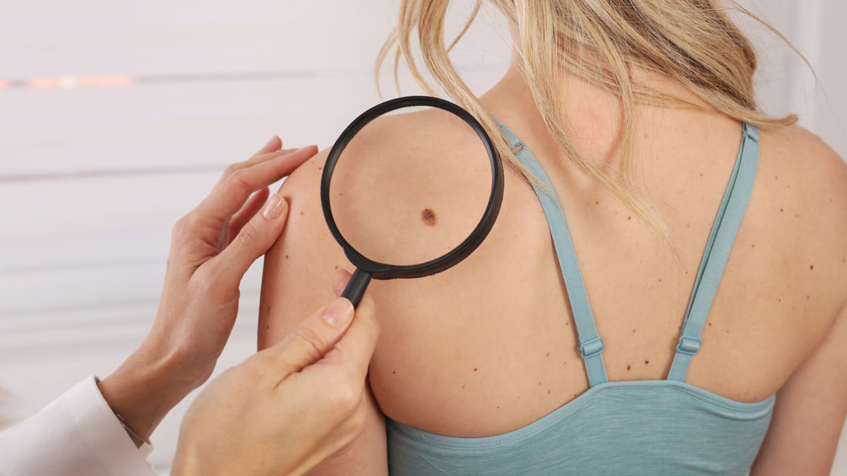 back of person wearing tank top with doctor holding magnifying glass looking at skin spot on their shoulder