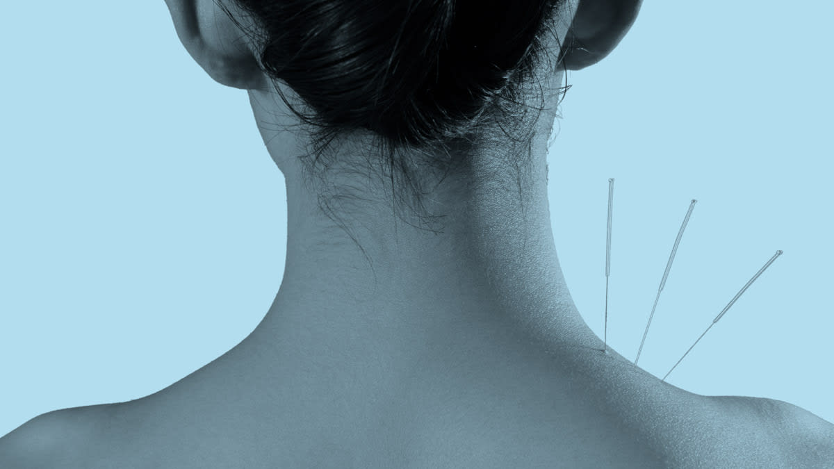 detail of back of person's head and neck with 3 acupuncture needles in their neck