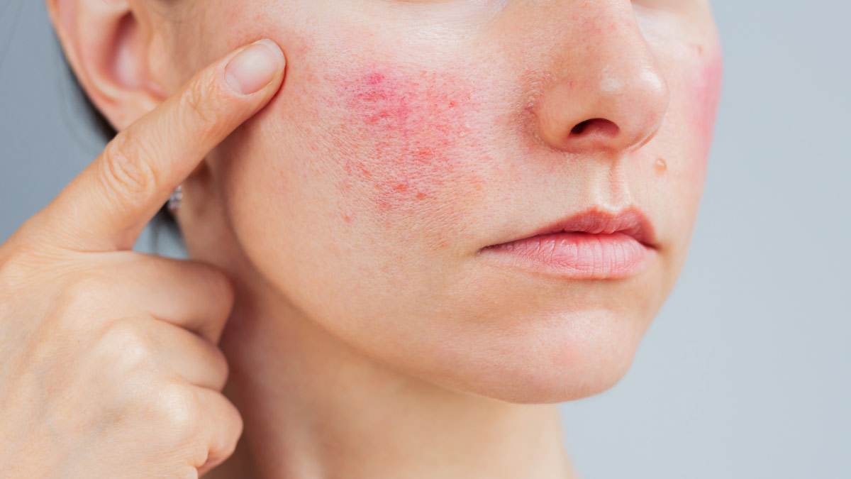 close up of person holding hand next to face, pointing to cheeks that have rosacea