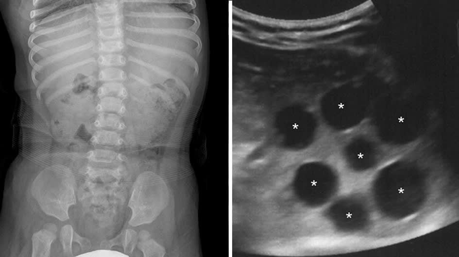 An X-ray (left) of a 12-month old girl taken in an emergency room failed to identify the cause of the child’s symptoms. But an ultrasound (right) ordered afterwards found seven of them.