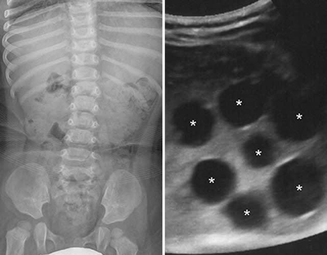 An X-ray (left) of a 12-month old girl taken in an emergency room failed to identify the cause of the child’s symptoms. But an ultrasound (right) ordered afterwards found seven of them.