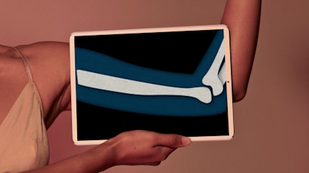 close up of hand holding tablet up agqainst their other arm, tablet showing x-ray of their arm
