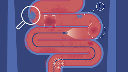 Illustration of a colon being examined endoscopically.