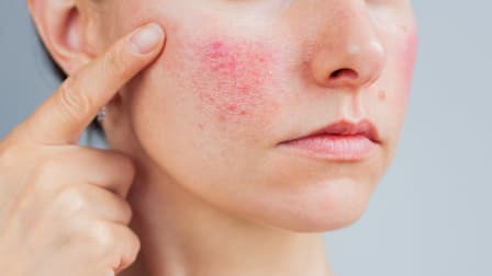 close up of person holding hand next to face, pointing to cheeks that have rosacea
