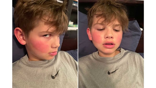 Child displaying a bright red inflamed area on their cheeks
