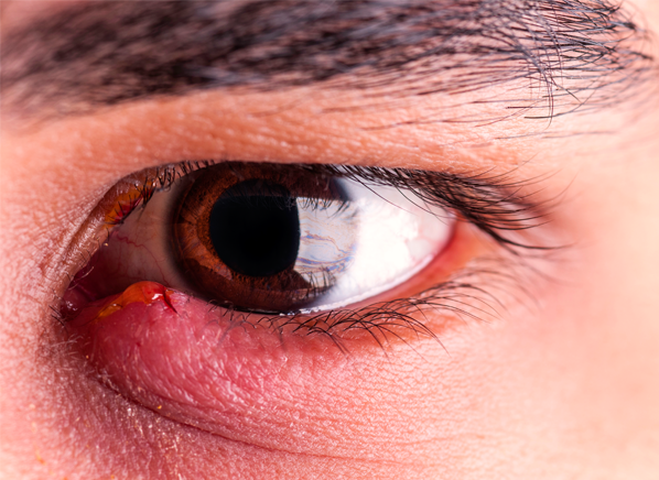 how-to-treat-and-prevent-a-stye-in-your-eye-consumer-reports