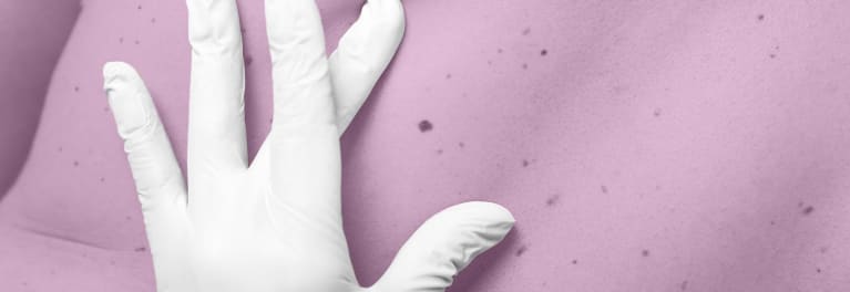 A doctor is examining a young woman's mole for signs of skin cancer.