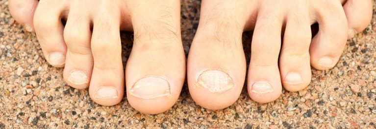The second and third toes on these feet are examples of hammertoes. Hammertoe can cause foot pain and walking problems. 