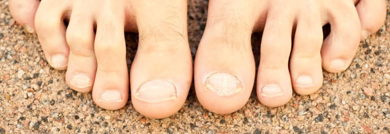 What Can I Do To Relieve Hammertoe Pain Consumer Reports